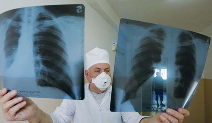 March 24 marks World Tuberculosis Day