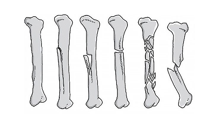 Healthy morning: Fractures