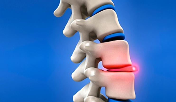 Healthy Morning: spinal disc herniation