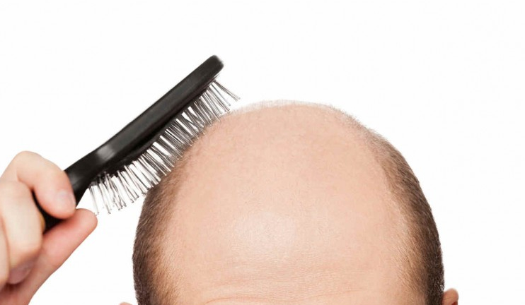 Healthy Morning: Baldness