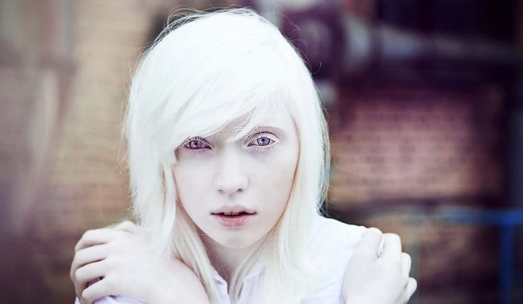 Healthy Morning: Albinism