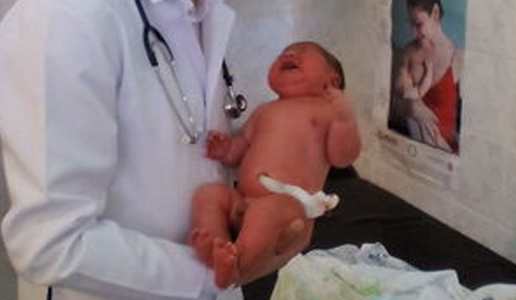 A macrosomic baby born in Achajur community