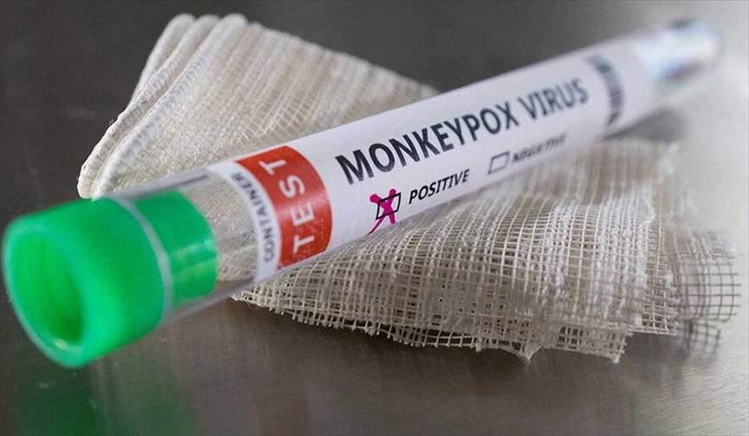 Russian patient has light form of monkeypox: sanitary watchdog