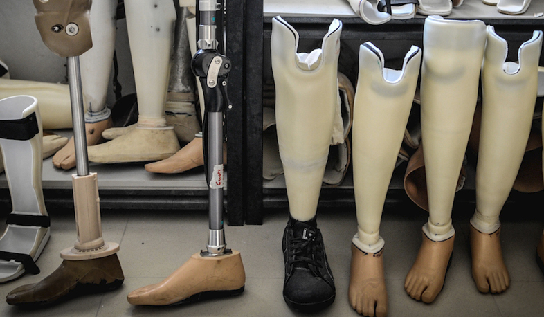 People with disabilities face prosthesis related issues