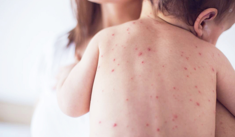 Health Ministry warns about measles danger