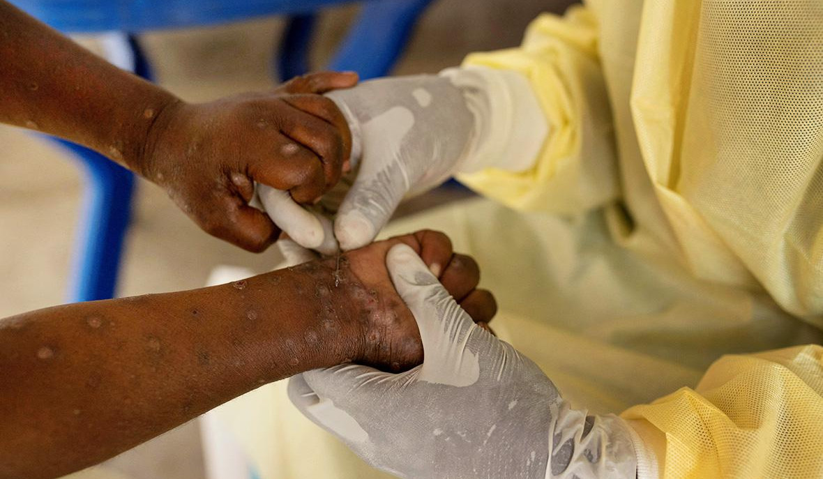 'No need to close borders', say WHO, IFRC after mpox detected outside Africa