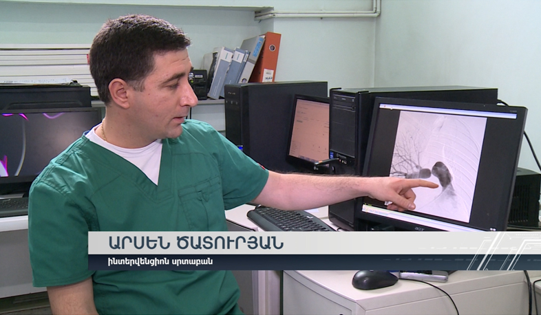 Pulmonary artery stent implanted in Armenia